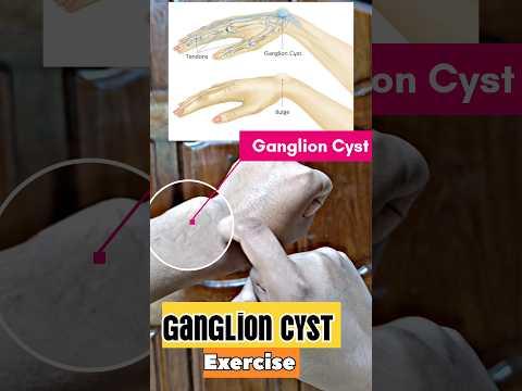 Bài tập cho u nang găng tay